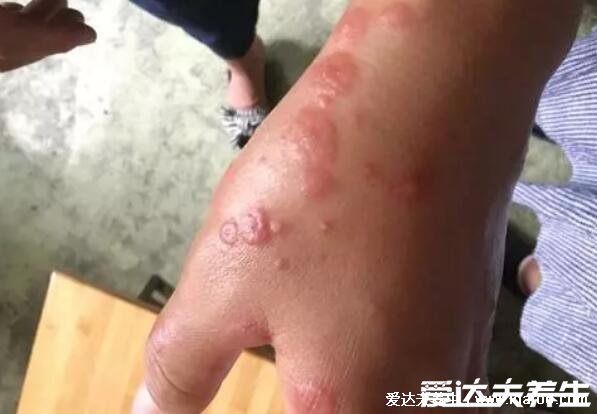 艾滋病的初期症状和身体反应,艾滋病初期手上水泡图片