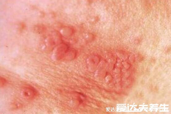 艾滋病的初期症状和身体反应,艾滋病初期手上水泡图片