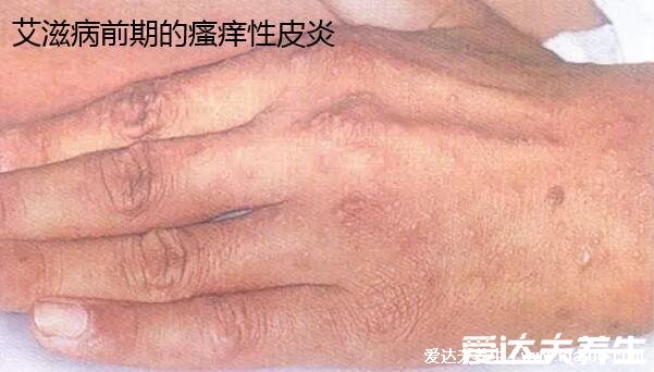 艾滋病的初期症状和身体反应,艾滋病初期手上水泡图片