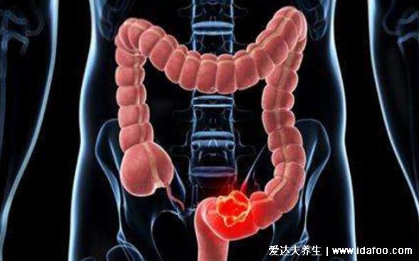 直肠癌早期的5大症状,左下腹肛门隐隐作痛伴随大便变细带血