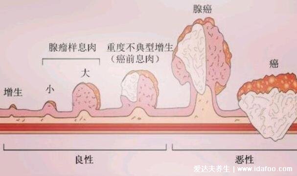 直肠癌早期的5大症状,左下腹肛门隐隐作痛伴随大便变细带血