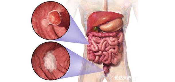 直肠癌早期的5大症状,左下腹肛门隐隐作痛伴随大便变细带血
