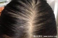 一熬夜就掉头发是什么原因,熬夜久了头容