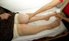 尿毒症有些什么症状,警惕面色泛黄全身浮