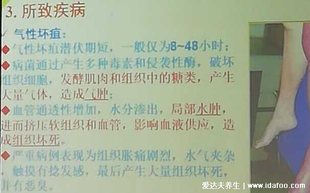 气性坏疽为什么要隔离,传染性极强还会导致残废或死亡(图片)