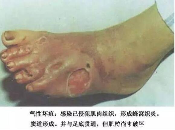 气性坏疽为什么要隔离,传染性极强还会导致残废或死亡(图片)