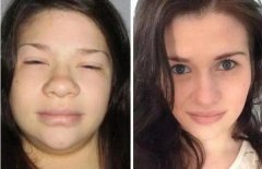 甲减的症状与危害女性,容貌异常还影响生