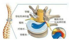 腰椎间盘突出压迫神经腿疼怎么治，药物和