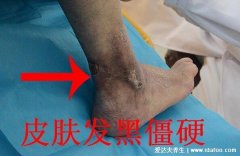 4大糖尿病足的早期症状图片,双脚脱皮伴随