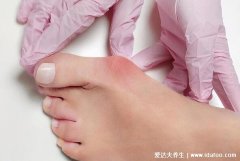 为什么会长鸡眼是怎么形成的，脚上长鸡眼