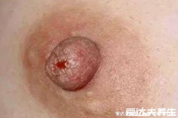 乳腺癌晚期能活多久,乳腺癌早期症状图片