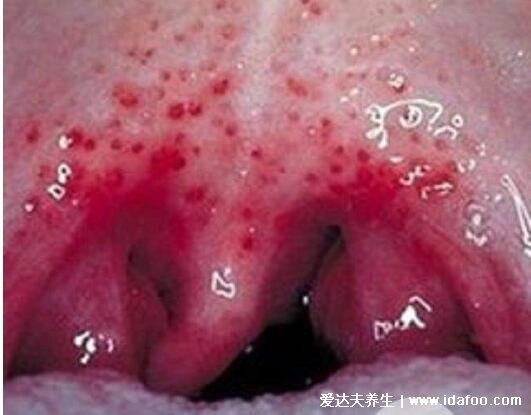 女性咽喉癌的早期症状,五大早期症状明显感觉咽喉有异物(图片)