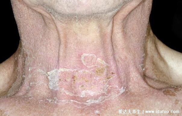 女性咽喉癌的早期症状,五大早期症状明显感觉咽喉有异物(图片)