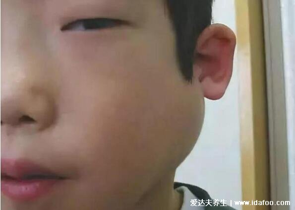 腮腺炎的症状图片,高烧后出现耳垂周围部位肿大(警惕并发症)