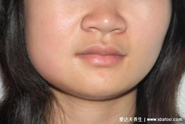 腮腺炎的症状图片,高烧后出现耳垂周围部位肿大(警惕并发症)