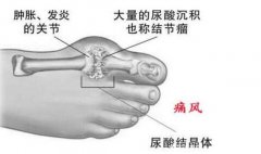 痛风的快速止痛的方法,5个方法非常有效
