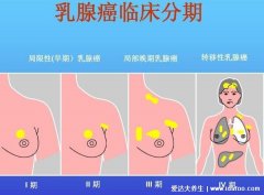 乳腺癌晚期能活多久,乳腺癌早期症状图片