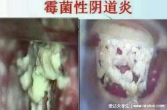 霉菌性阴炎症状表现,豆腐渣白带伴随瘙痒