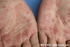 梅毒初期症状及图片,下面长不痛不痒小红