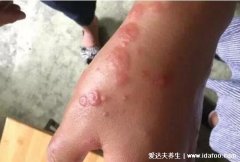 艾滋病初期小红点照片,早期的瘙痒性皮炎