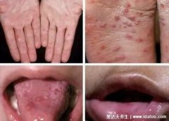 小孩口足手病轻微图片,出现感冒症状然后