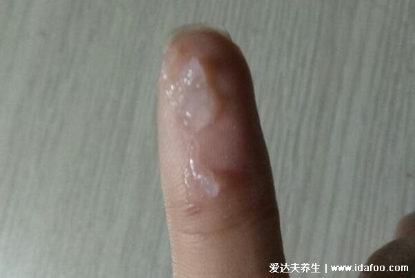 女孩初潮前的白带图片及症状,红棕色带有少量血丝的白带