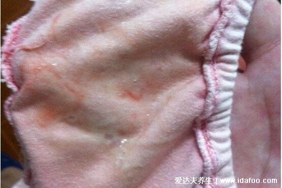 女孩初潮前的白带图片及症状,红棕色带有少量血丝的白带