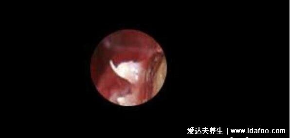 尖湿锐尤典型早期图片及症状,起初淡红色小丘疹3-5天长成菜花状疣体