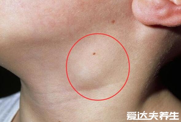 腋下淋巴癌早期症状图片,腋下红肿有明显瘙痒感会扩散