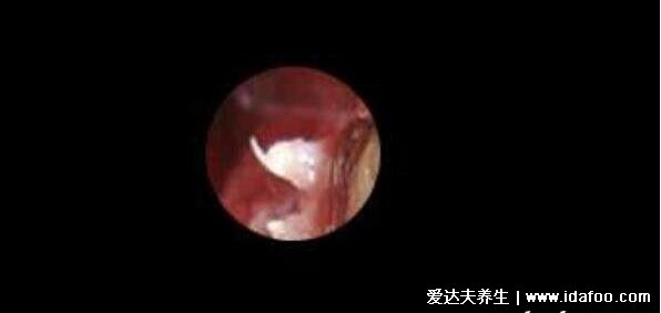 男女尖疣湿早期症状图片,从米粒大的丘疹长成菜花样的疙瘩