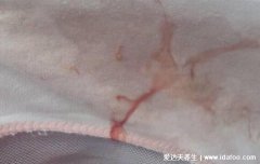 女孩初潮前的白带图片及症状,红棕色带有