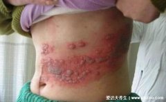 带状疱疹疫苗有必要打吗，害怕承受剧烈神