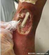 清创是什么意思，清理创口坏死从而加快伤