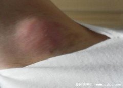 腋下淋巴癌早期症状图片，腋下红肿有明显