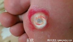 鸡眼和跖疣的区别图，跖疣数量多表面有黑