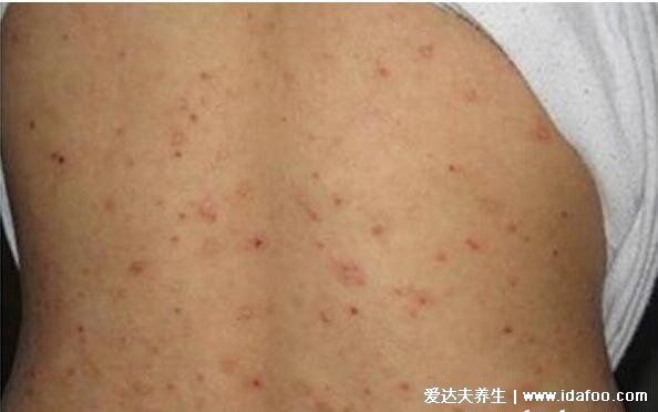 人身上被螨虫咬的图片,前胸后背长红疙瘩皮肤肉眼可见的变差