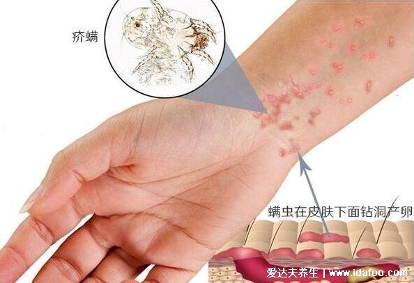 人身上被螨虫咬的图片,前胸后背长红疙瘩皮肤肉眼可见的变差