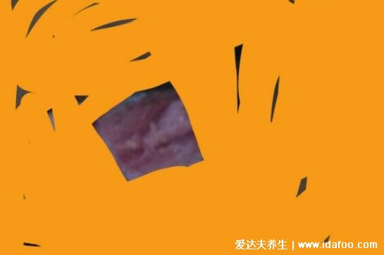 男女尖疣湿早期症状图片,真假尖疣湿从它的外形看出(胆小勿入)