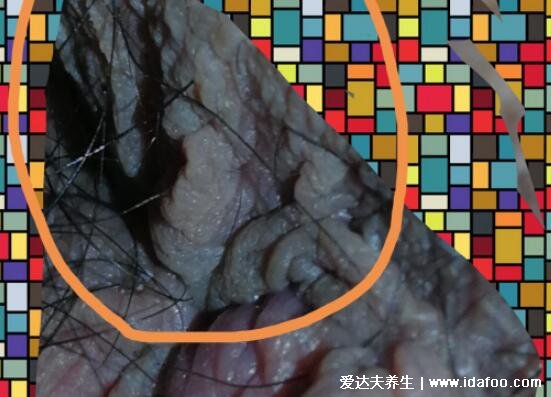 男女尖疣湿早期症状图片,真假尖疣湿从它的外形看出(胆小勿入)