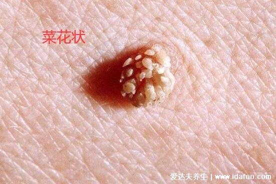男女尖疣湿早期症状图片,真假尖疣湿从它的外形看出(胆小勿入)