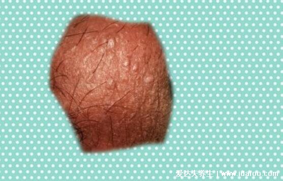 男女尖疣湿早期症状图片,真假尖疣湿从它的外形看出(胆小勿入)
