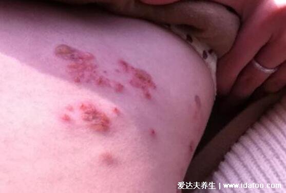 蛇缠腰会传染吗一般多久能好,护理得当两周可痊愈(会传染)