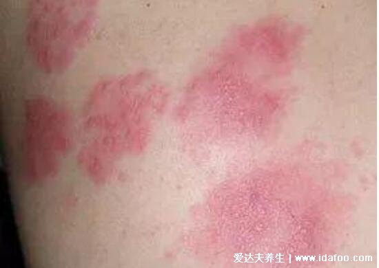 蛇缠腰会传染吗一般多久能好,护理得当两周可痊愈(会传染)