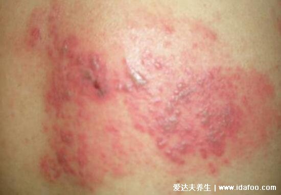 蛇缠腰会传染吗一般多久能好,护理得当两周可痊愈(会传染)