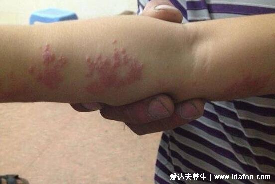 蛇缠腰会传染吗一般多久能好,护理得当两周可痊愈(会传染)