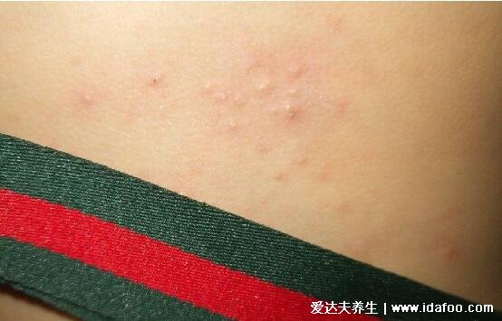 蛇缠腰会传染吗一般多久能好,护理得当两周可痊愈(会传染)