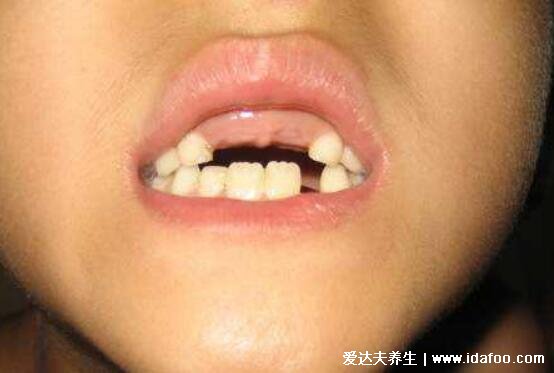 做梦梦到牙齿掉了是什么意思,可能预示着"家有丧事"多注意长辈