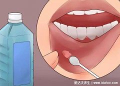 口腔溃疡怎么办最快最有效的方法,不用吃