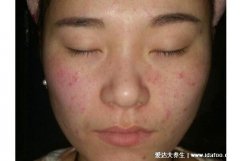 人身上被螨虫咬的图片,前胸后背长红疙瘩