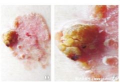 男女尖疣湿早期症状图片,真假尖疣湿从它